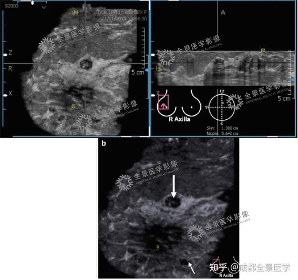 两名女士体检发现乳腺结节，结果却完全不同…… 知乎