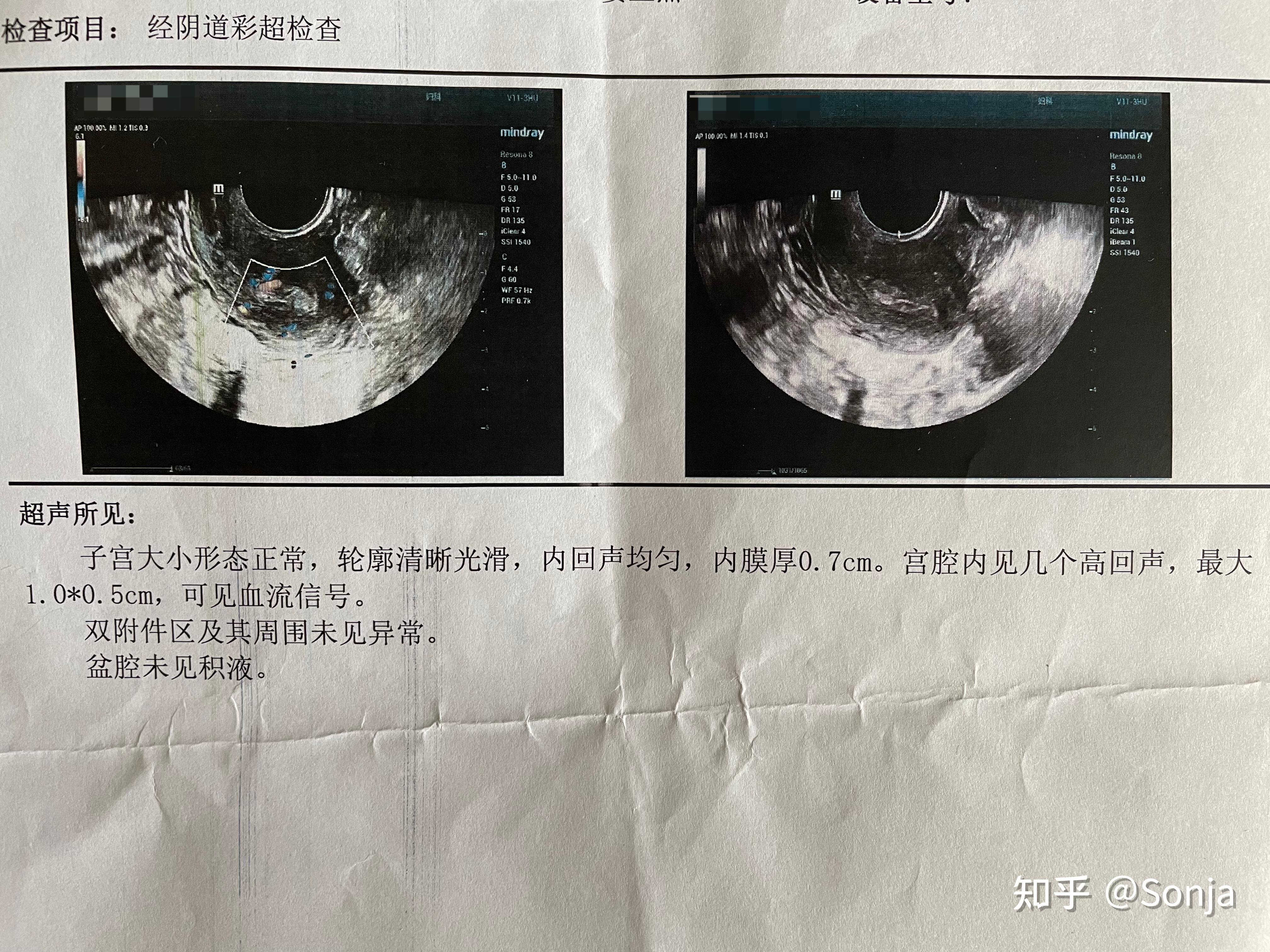 宮腔鏡下切除子宮內膜息肉人生第一次全麻手術