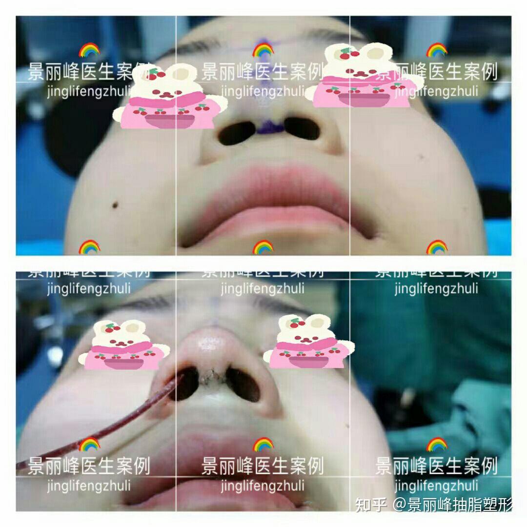 上海爱莫儿医疗美容肋软骨隆鼻怎么样_恢复过程_效果如何_娜娜小花花整形日记4.21_新氧美容整形