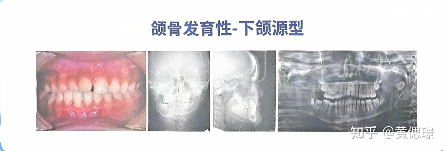 正畸诊断沈刚分类之偏颌 - 知乎