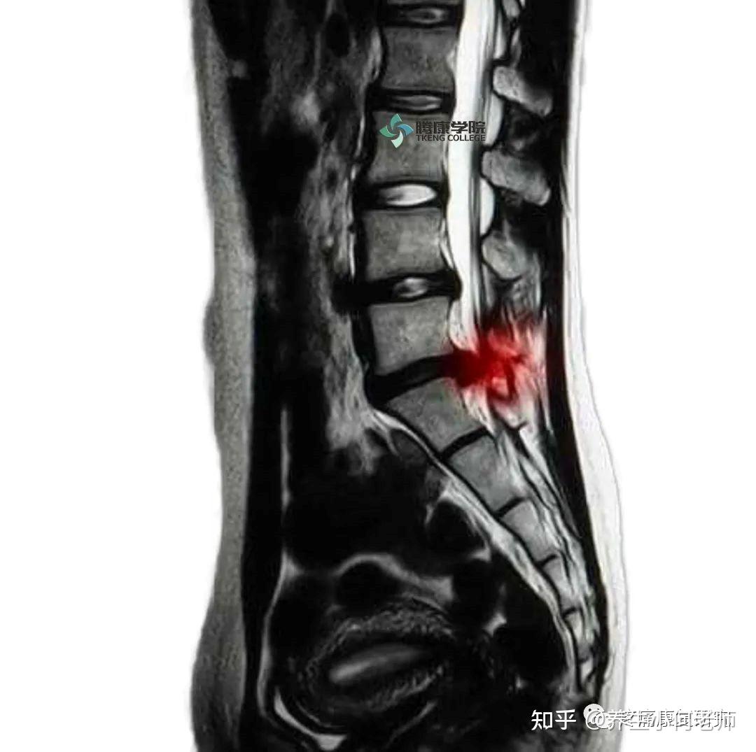 腰椎间盘突出症的相关解剖、诱因、症状、诊断及体格检查和治疗 知乎 
