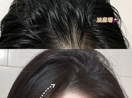 好用到飞起的洗发水有哪些软塌油头螨虫痘痘头屑瘙痒脱发断发终于得救