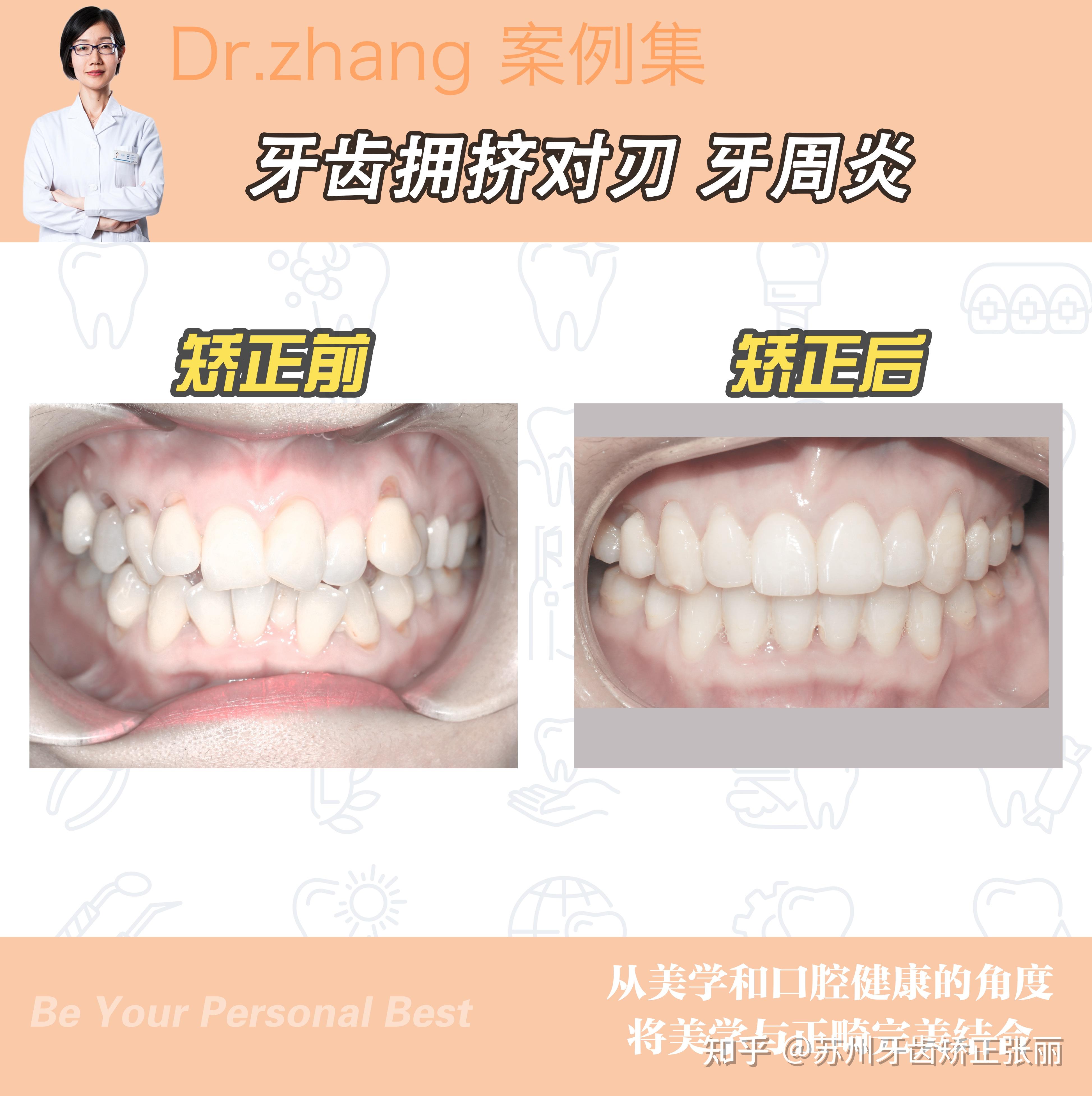 广州圣贝牙齿矫正案例分享：上下牙列不齐+个别牙反颌+中线不齐矫正后的变化 - 知乎