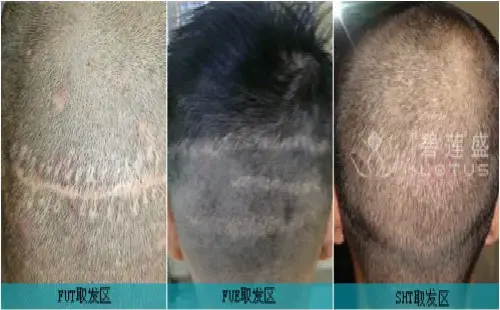 头皮烫坏后能植发吗吗(头皮被烫了还能长头发吗)