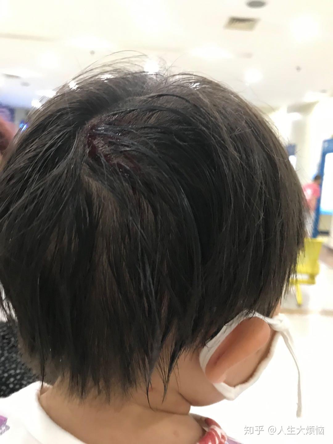 上脚不到2小时,宝宝就在家里滑倒了,摔得头破血流,浑身都是血