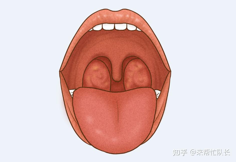 扁桃体周囊肿的类型有哪些?诱发因素有?日常需要注意什么?
