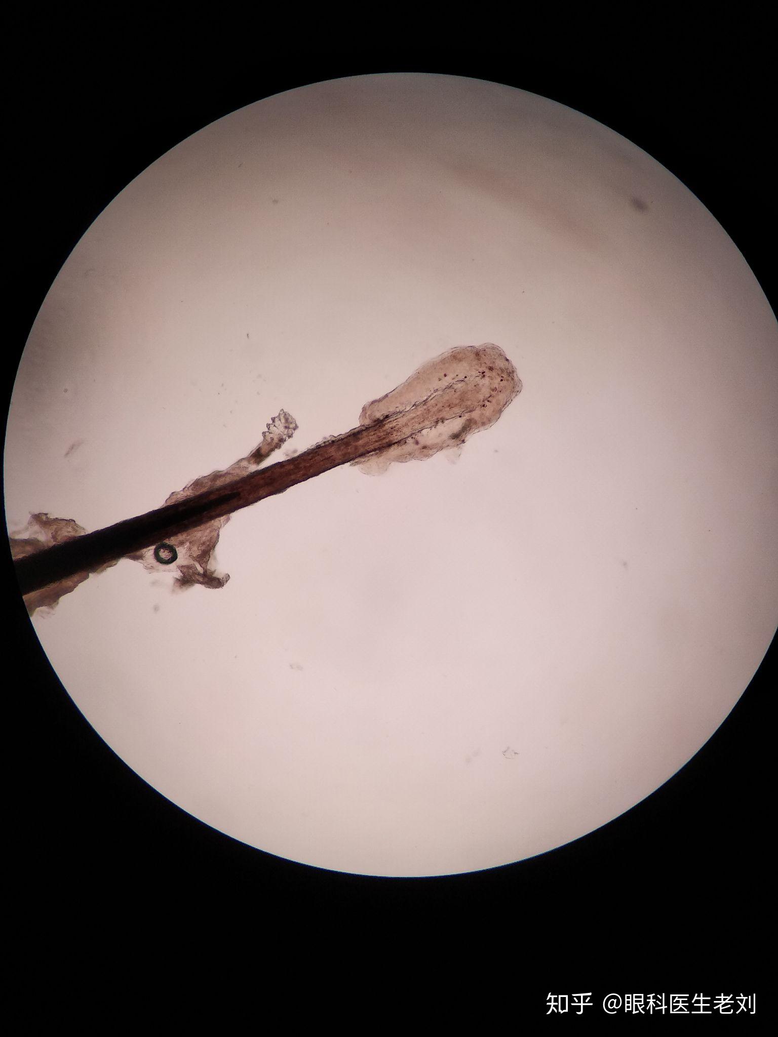 睫毛根部的蠕形螨 - 知乎