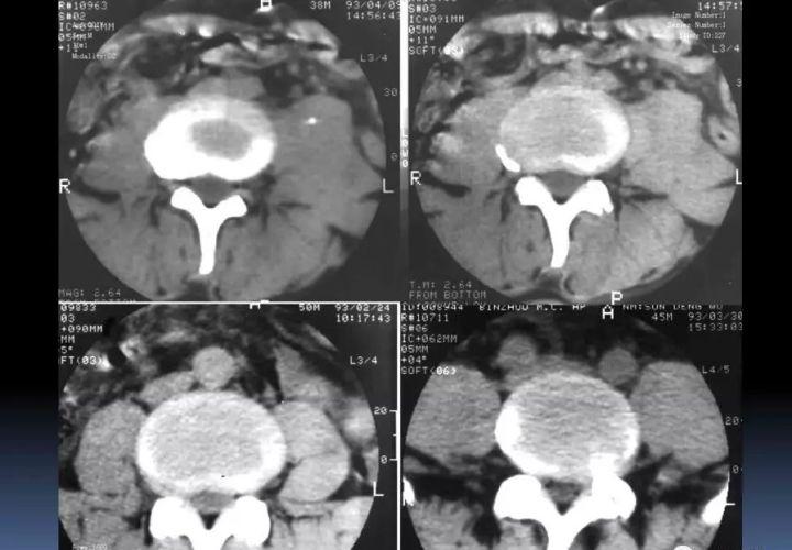 腰间盘突出ct图片