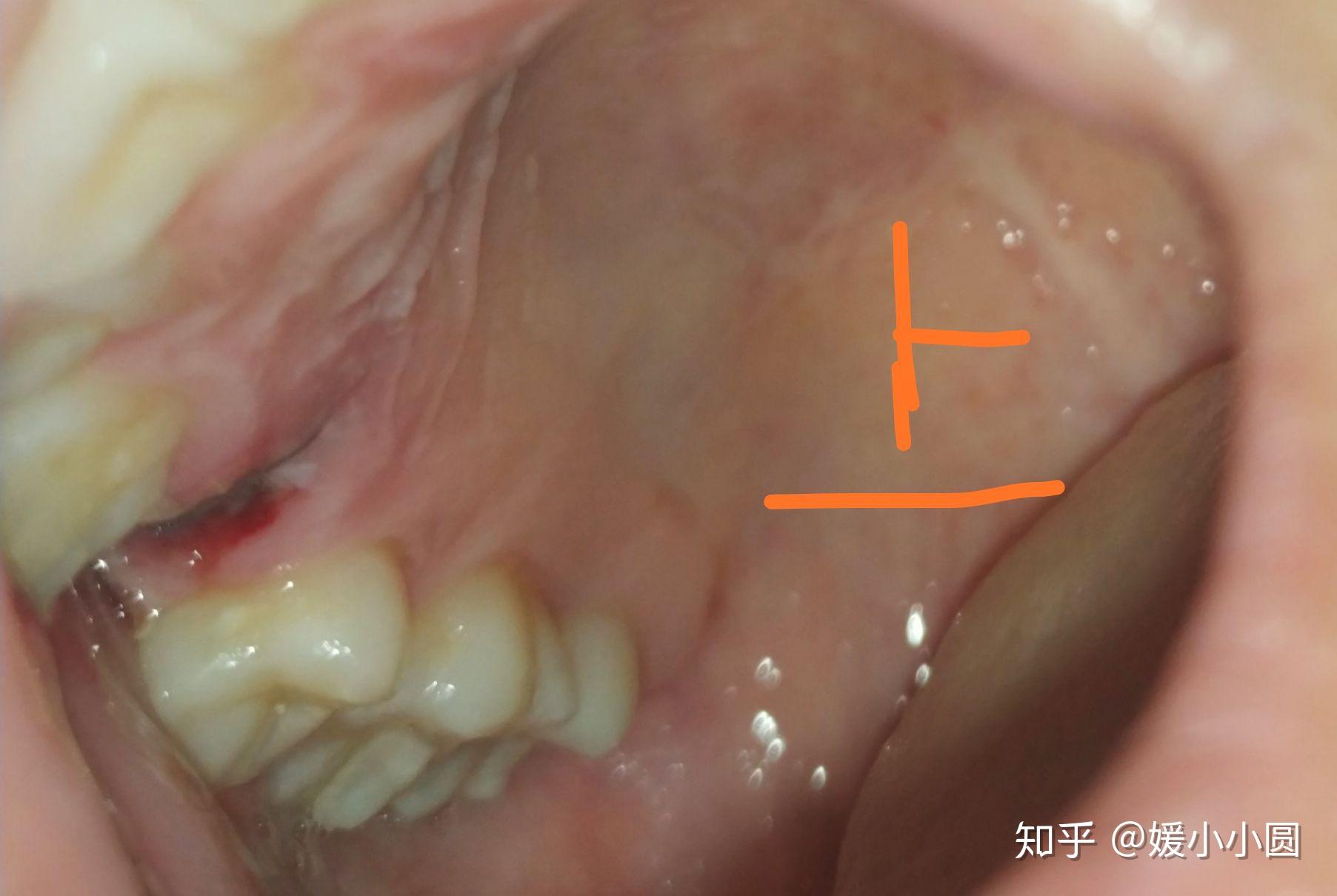 牙齒矯正拔牙恢復篇有圖可能有點血腥