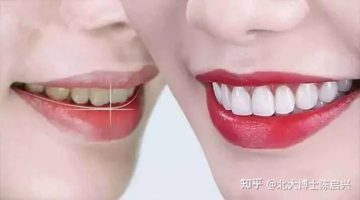 【口呼吸】唇舌肌训练,在家也能做 - 知乎