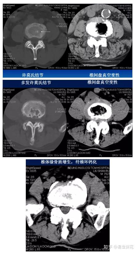 椎間盤層面(軟組織窗):觀察椎間盤,硬膜囊,神經根,韌帶等軟組