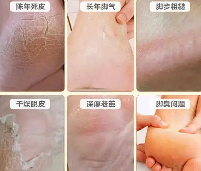 脚臭尴尬脚痒难忍用点这种散剂8秒解决连脱皮也好了