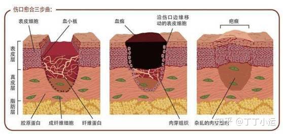 包皮术后疤痕的形成、预防和处理方法 - 知乎