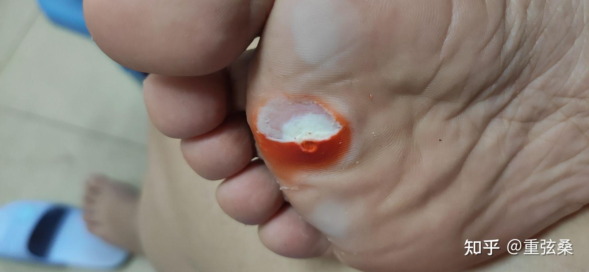 3去校医院看了一下,医生说是疣,可以激光,冷冻,我怕疼,医生说用鸡眼贴