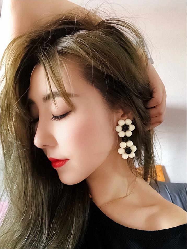 龅牙矫正案例再也不用羡慕别人的精致小脸