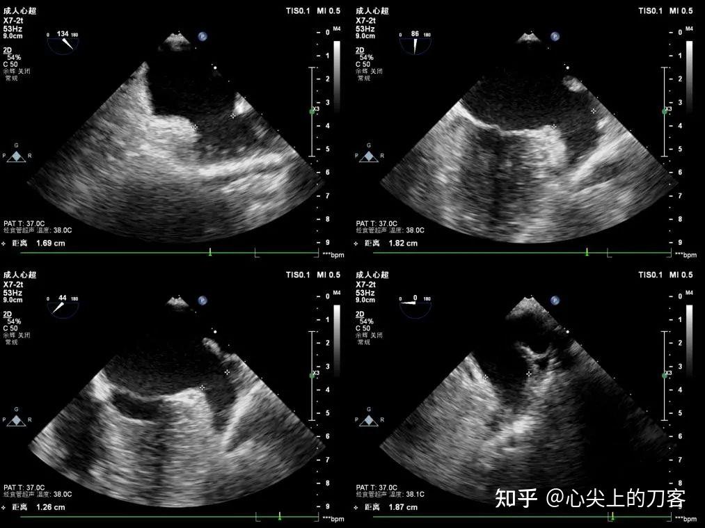 左心耳超声图图片
