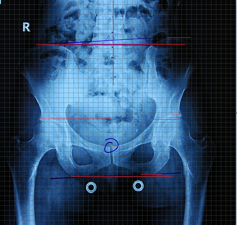 产后腰痛两个月--骨盆旋移x线表现