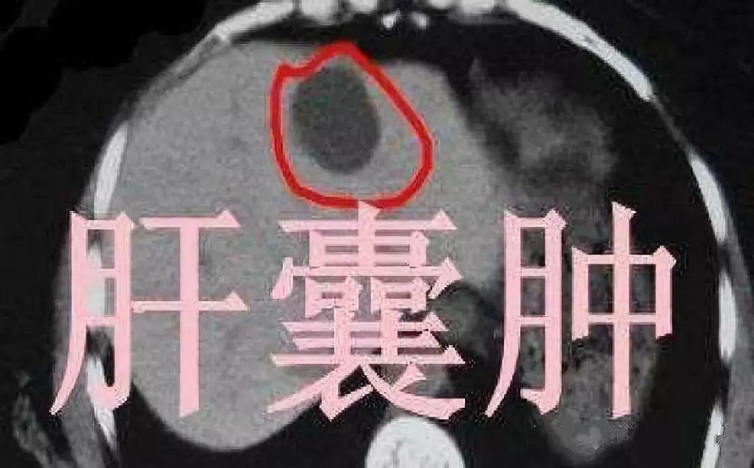 解析丨结节息肉囊肿增生哪个才是癌症的先兆