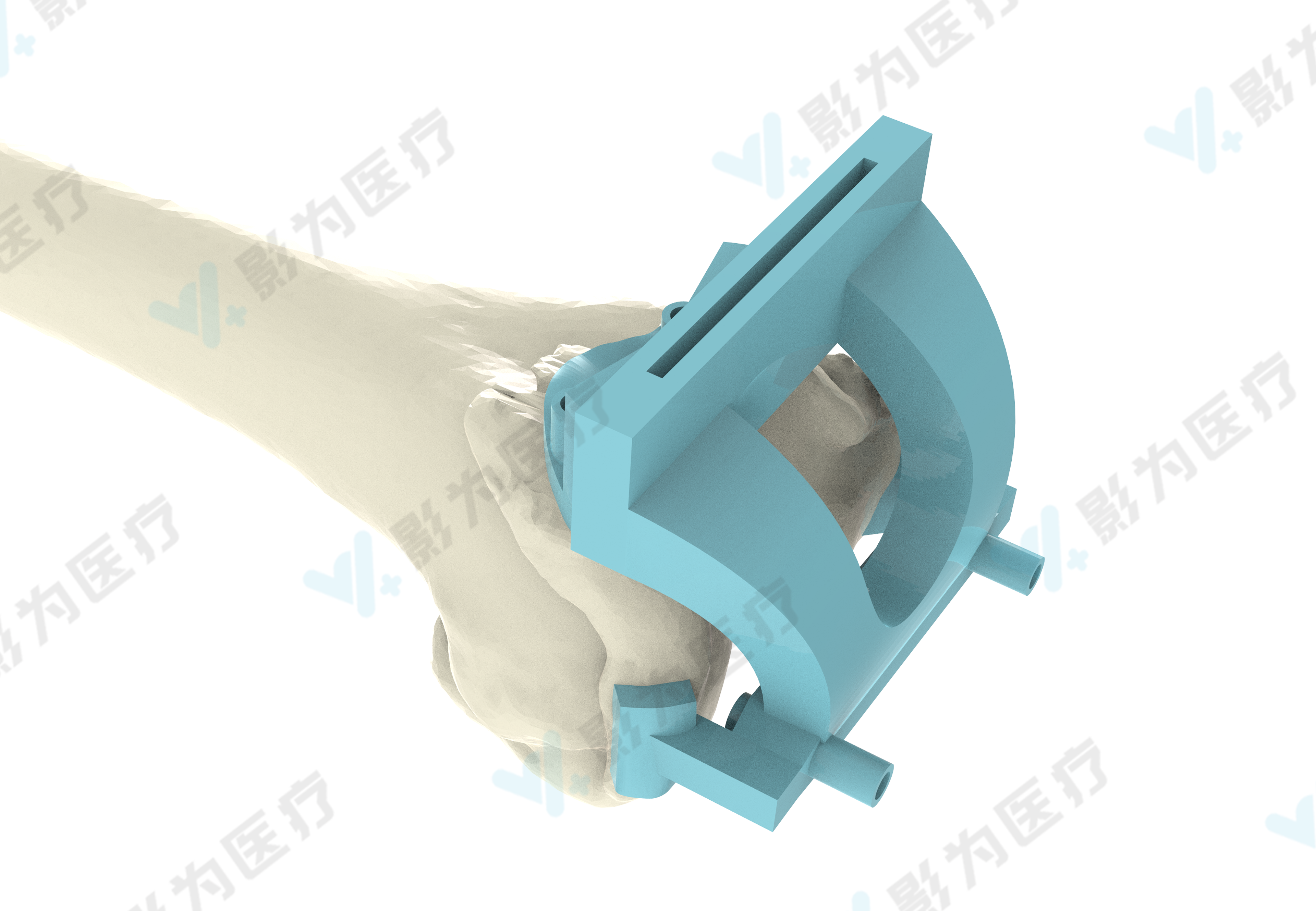 03影为tka截骨导板