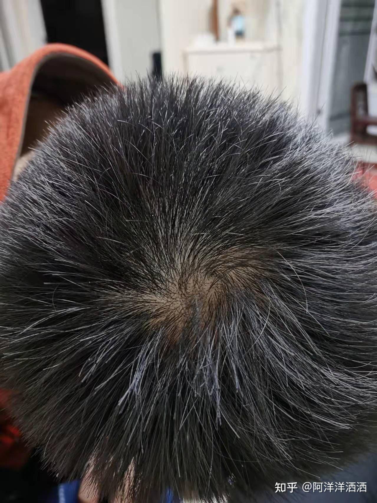 雄脱脂溢性脱发遗传性脱发治疗日记