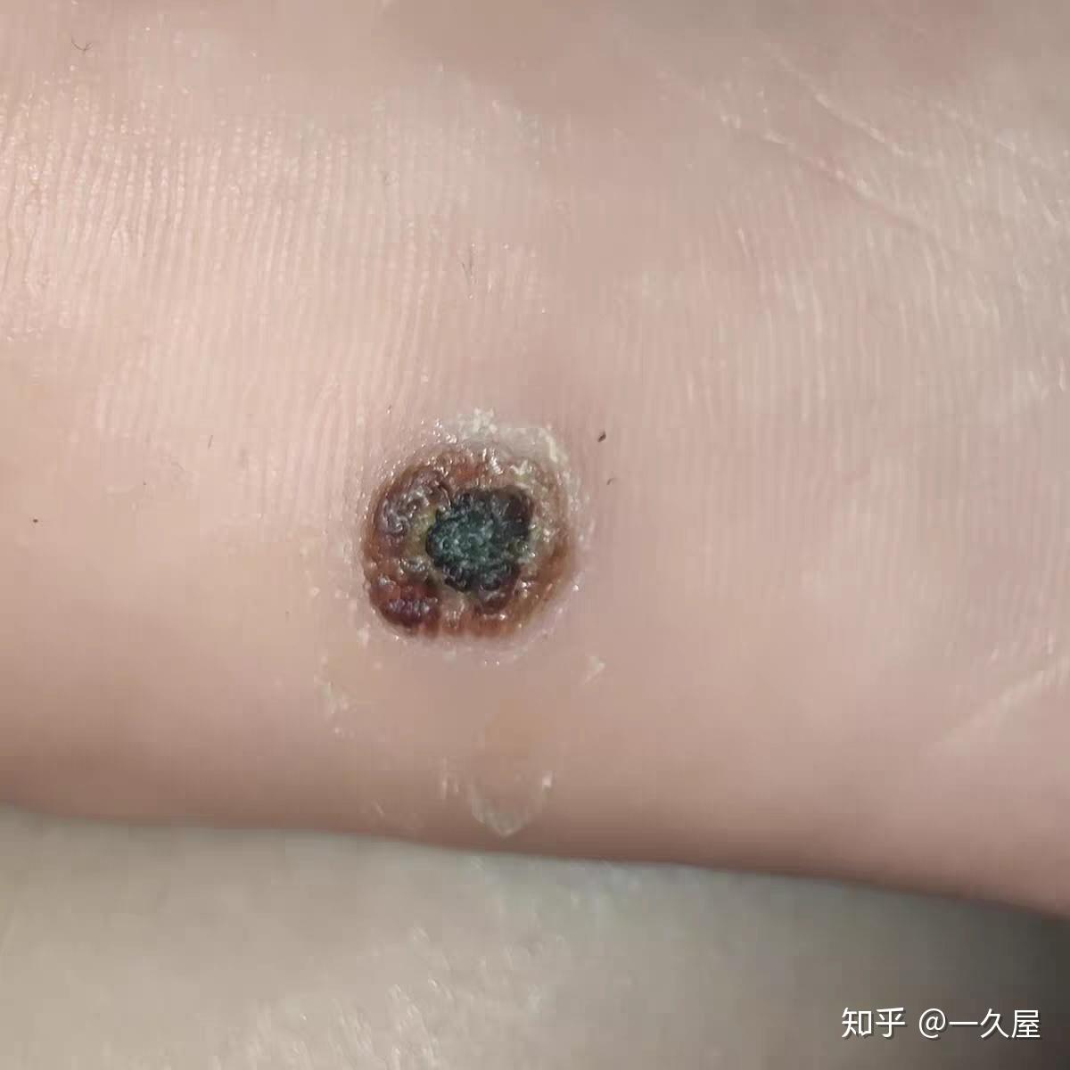 我的跖疣终于好了治疗过程