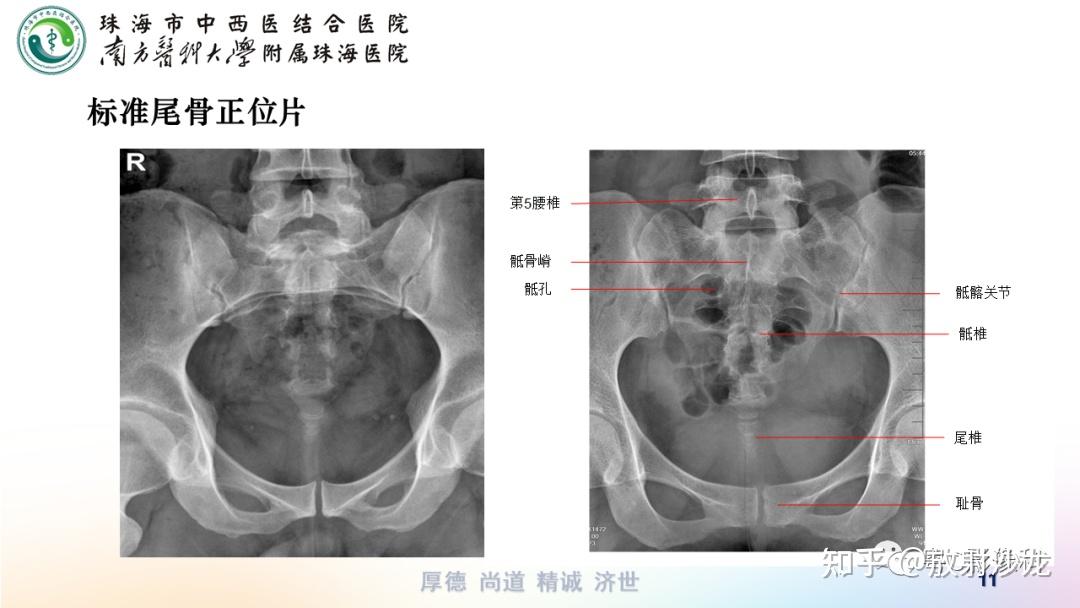 骶尾骨x线解剖图片