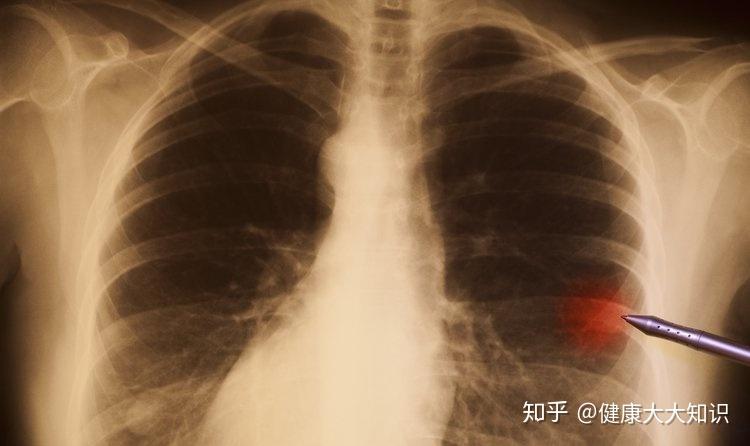 如何化痰快速化痰小妙招