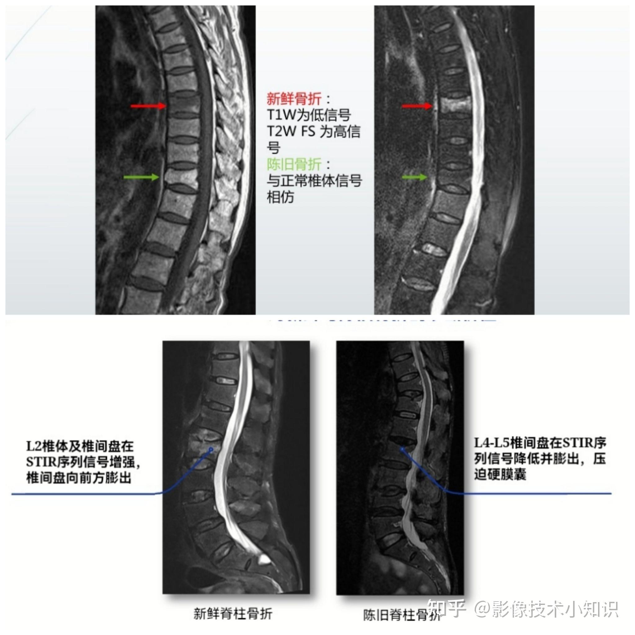 脊柱裂核磁图片