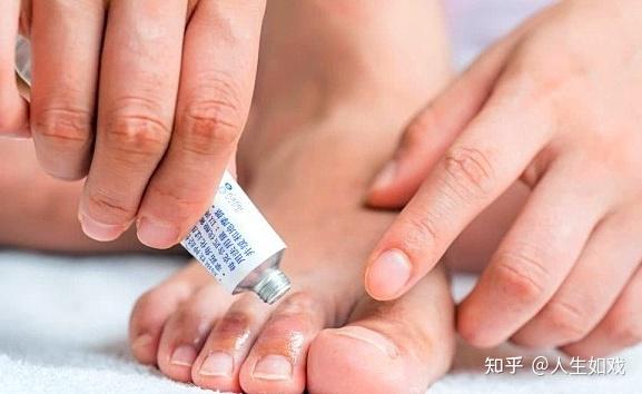 腳氣噴霧推薦腳氣怎麼治療能除根