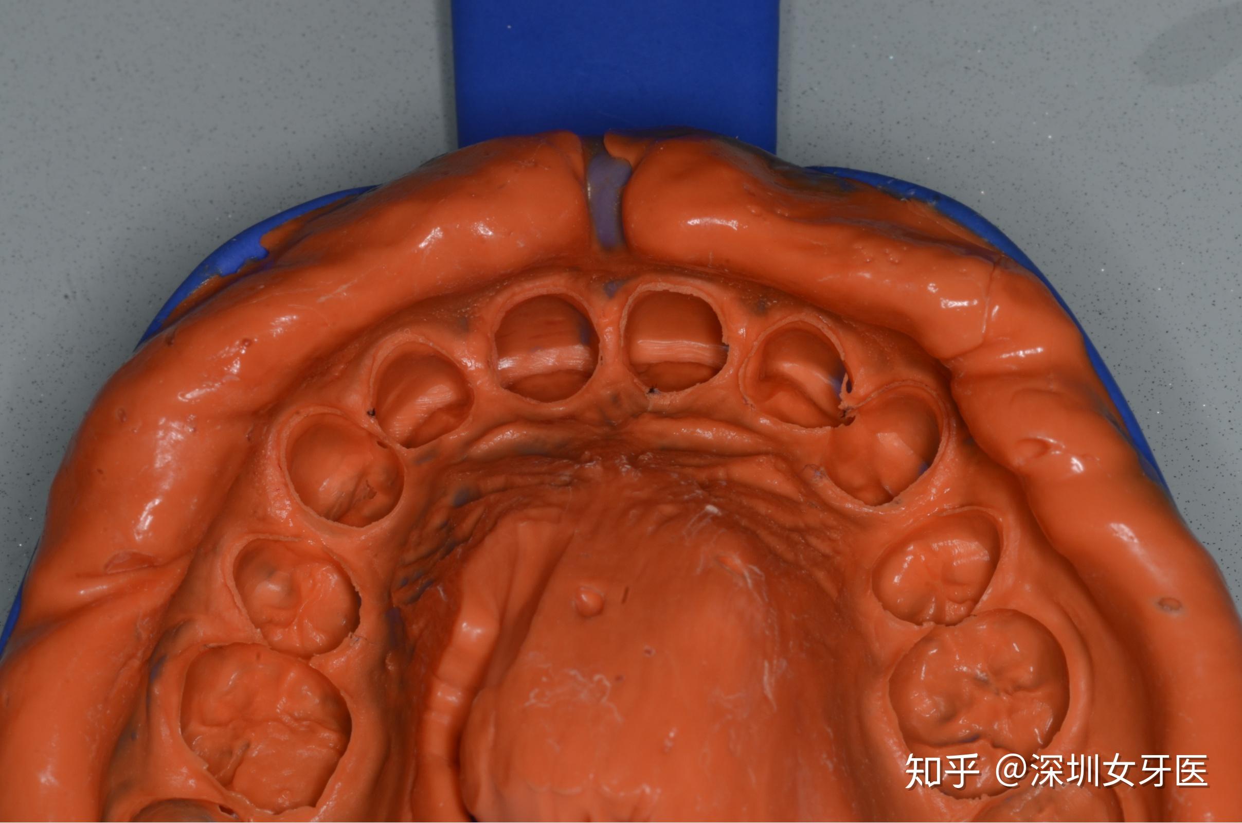 取模,制作蜡型3,备牙对牙齿表面进行处理,备牙磨牙,印取牙模送至工厂