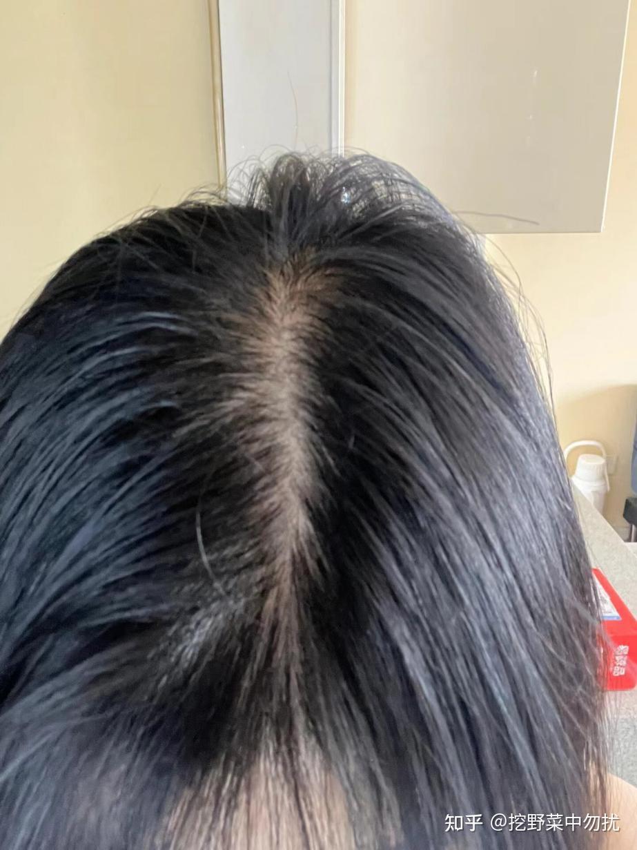 如何防止掉发,恢复发量?
