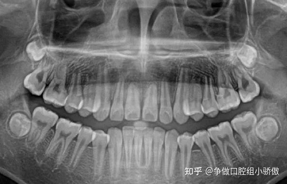 正畸该拔第几颗牙？ 知乎