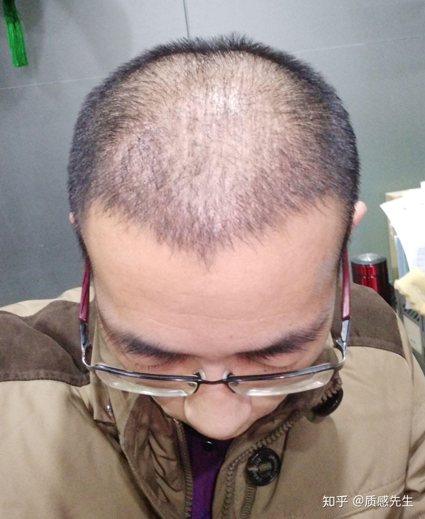 一个脱发患者的真实植发经历献给所有的脱发患者