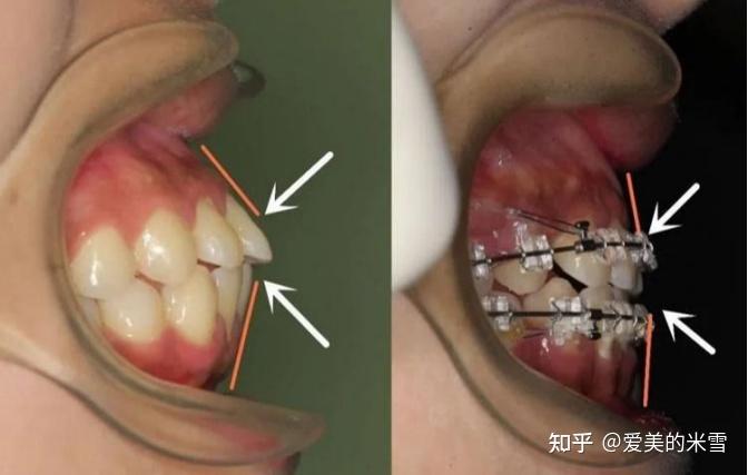 可能還有嘴巴閉合不全這類的情況,但牙性問題,鼻子和鼻基底位置並不會