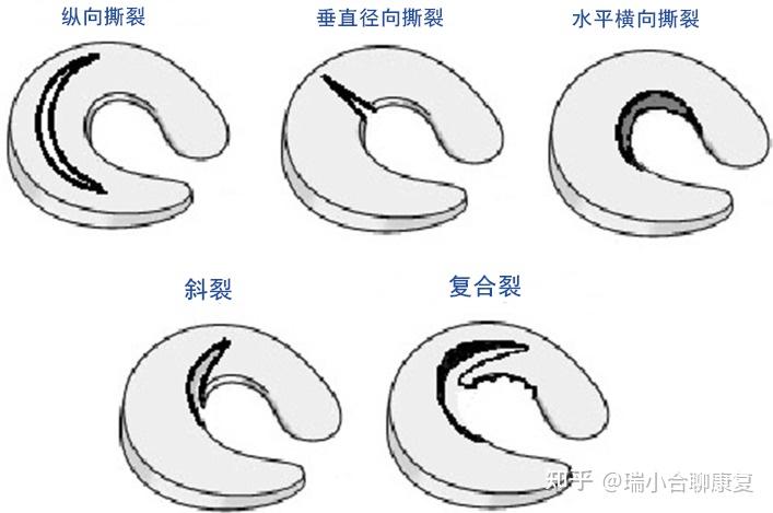 半月裂孔解剖图图片