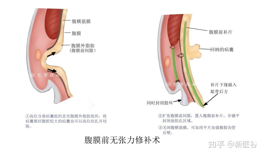 疝气无张力修补术图解图片