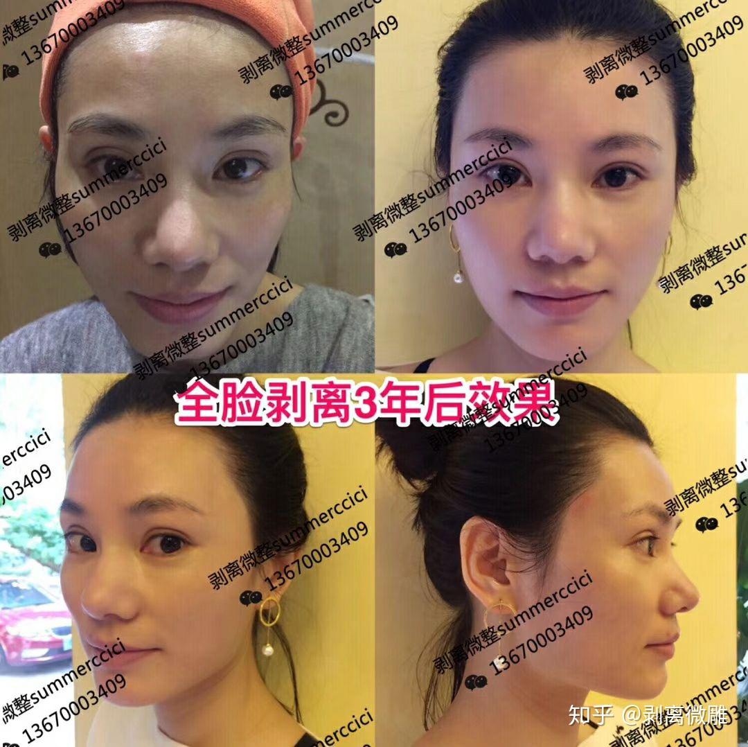 剥离微整 - 知乎