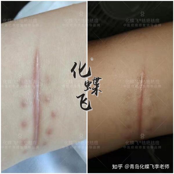 增生疤痕 - 知乎
