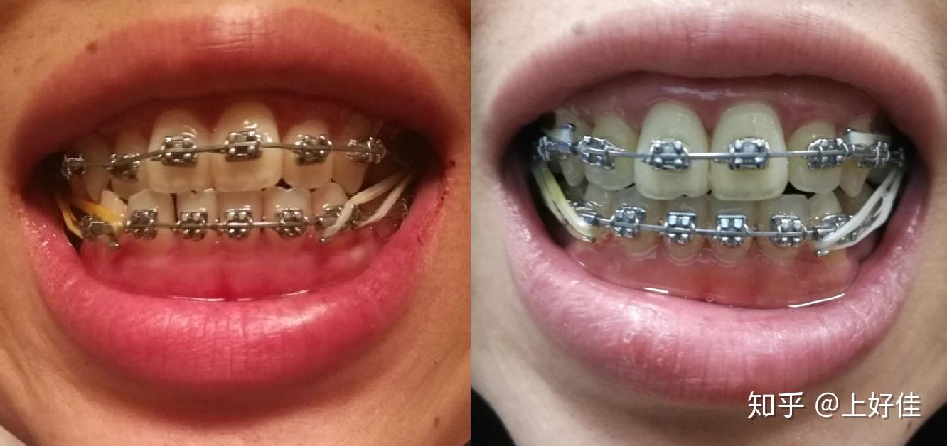 全同步带状弓整牙日记每周一更