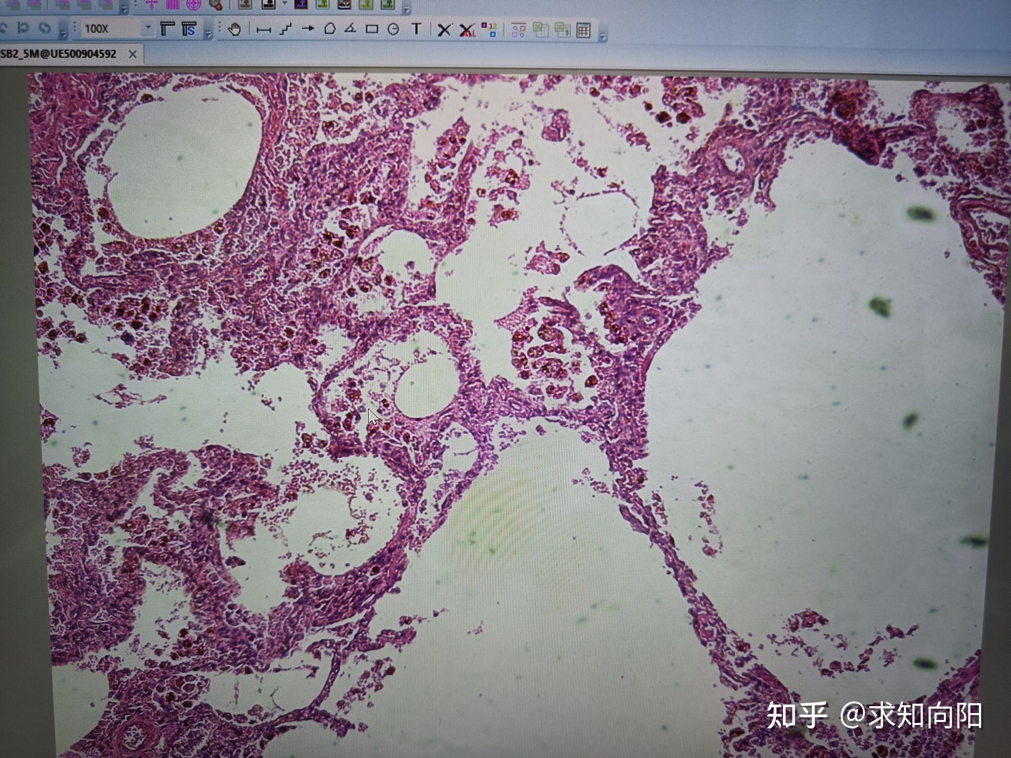 慢性肺淤血显微镜图片 - 知乎