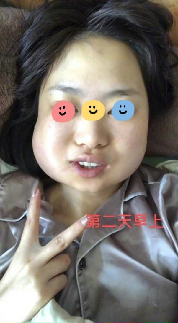 一次性拔完全部智齿后你的脸部会发生什么变化