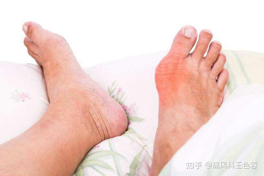 那麼主要出現的臨床症狀主要是大拇指關節以及踝關節又紅,又腫,又痛.