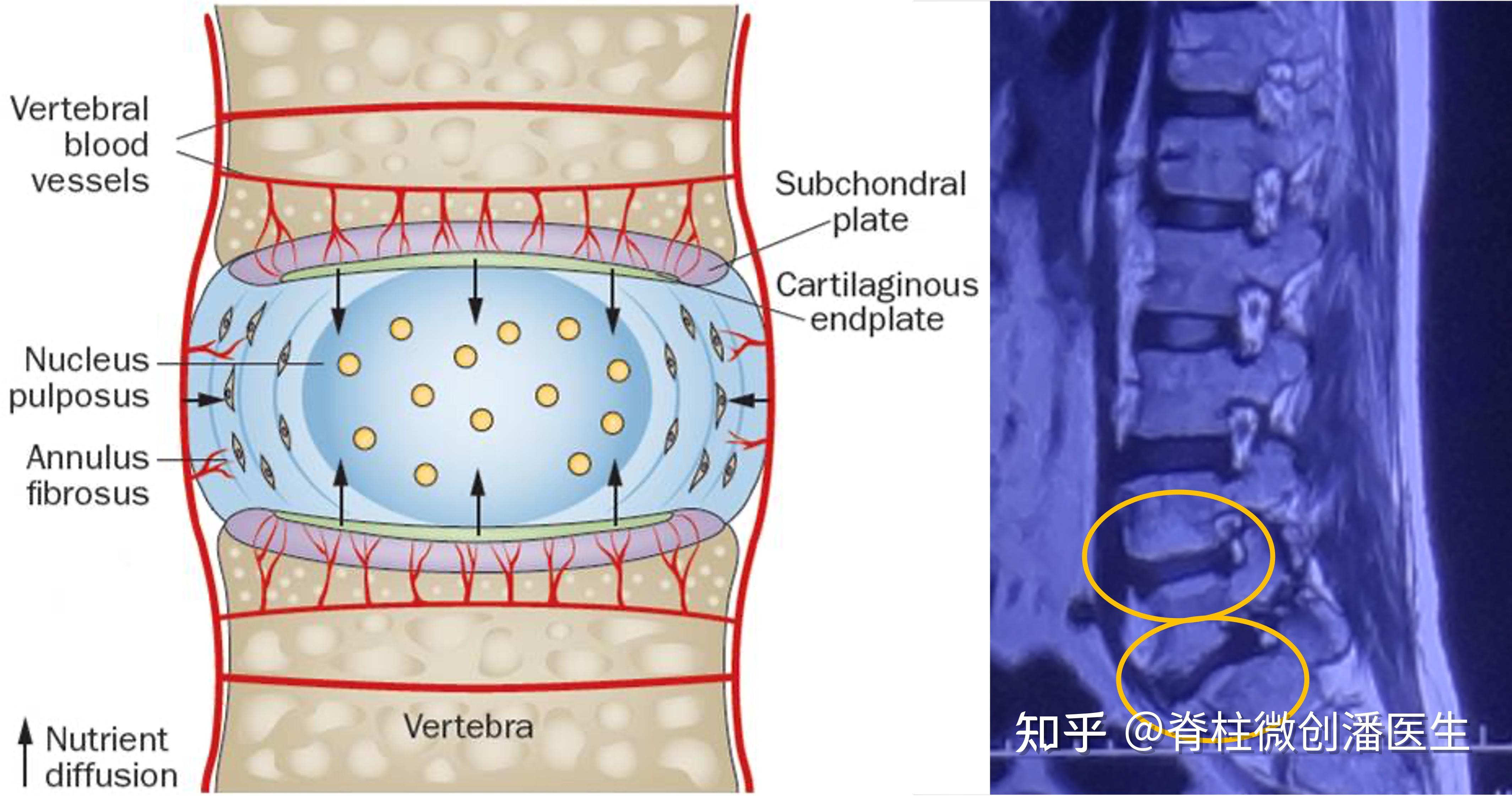 磁共振报告上写的终板炎是感染了吗?与腰痛有关系吗? - 知乎
