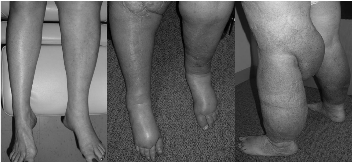 治疗:可以通过有氧锻炼以及举重(举重主要针对上肢淋巴水肿);复合减