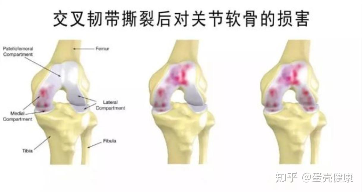 前交叉韧带损伤那点事---大白话版 - 知乎