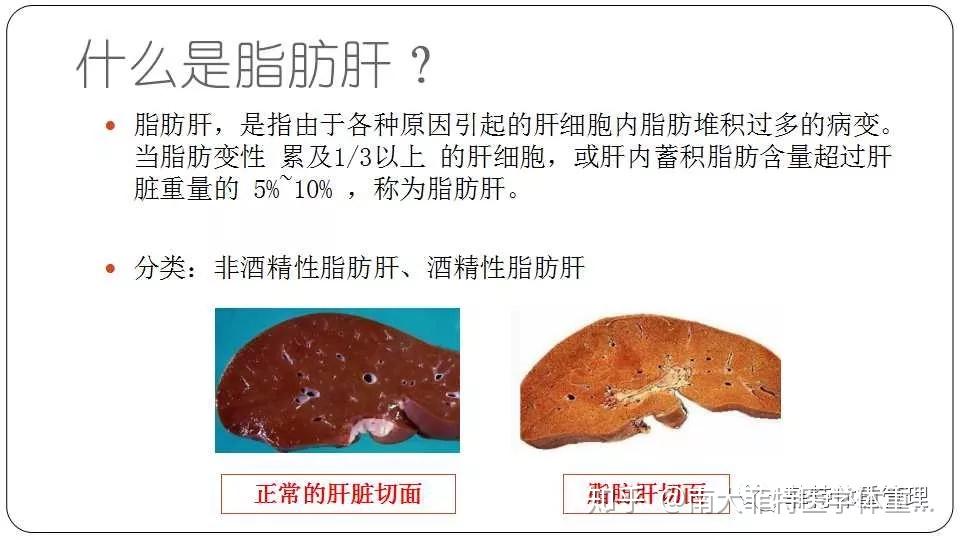【微课回顾】脂肪肝的饮食指导 知乎