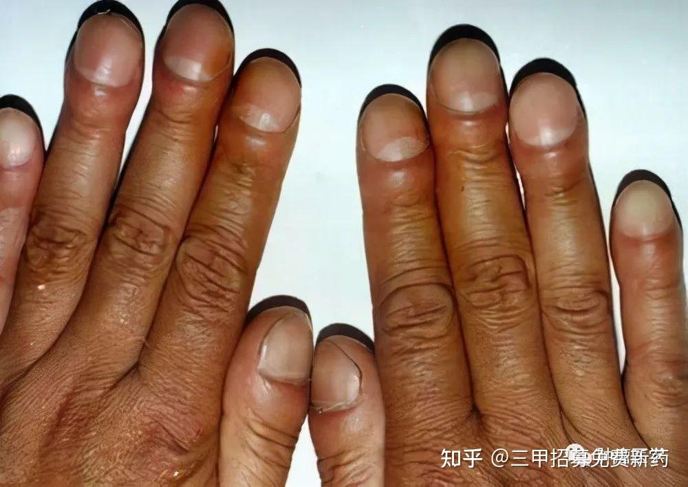 从手指也能看出肺癌提醒手指出现5个异常赶紧排查病因