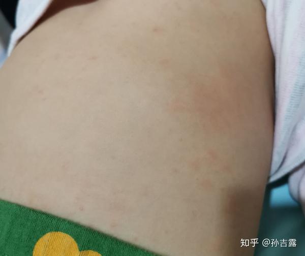 没想到,是川崎病