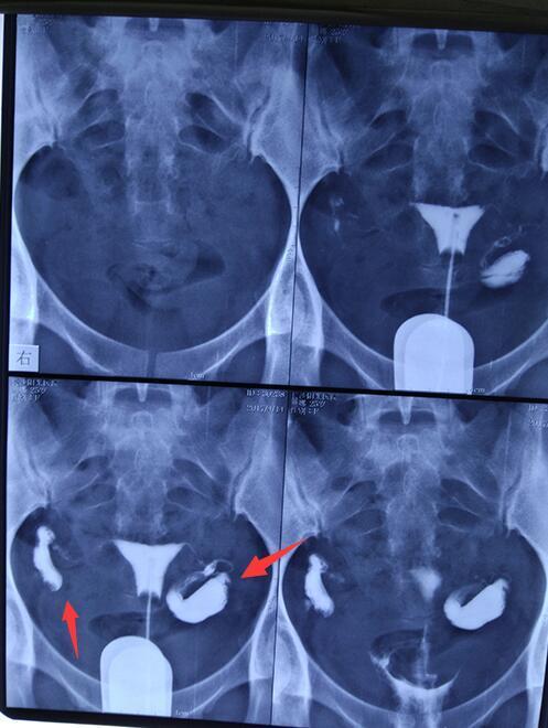 输卵管积水造影图片