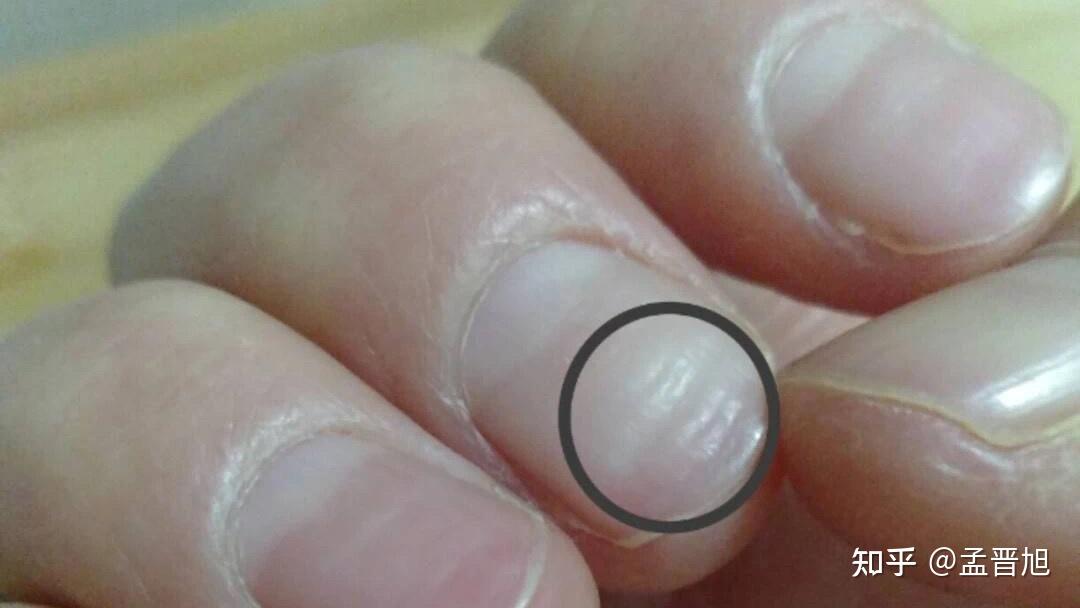指甲有竖纹不光滑，凹凸不平是什么原因，该怎么办？ - 知乎